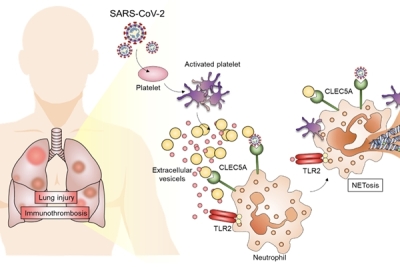 CLEC5A和TLR2是SARS-CoV-2冠狀病毒引發肺栓塞的關鍵